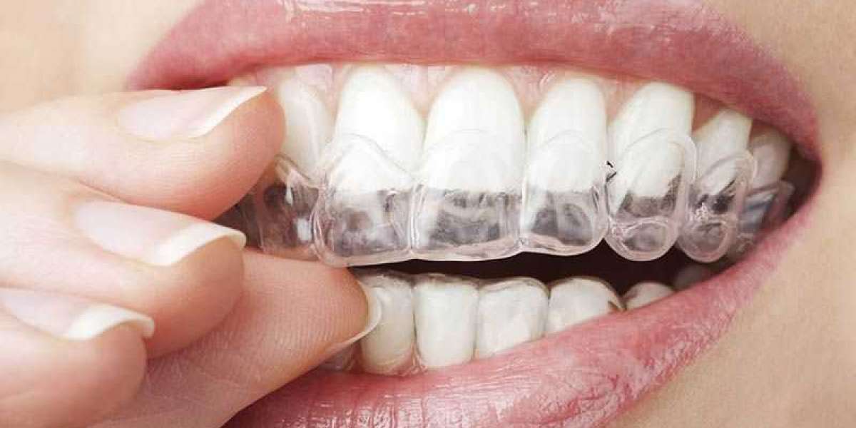 Can You Smoke with Invisalign Aligners?