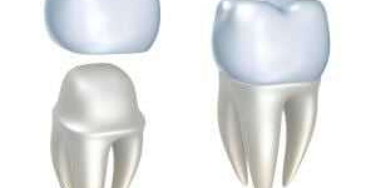 Dental Work in Bali : A review from Teeth Implants Patient