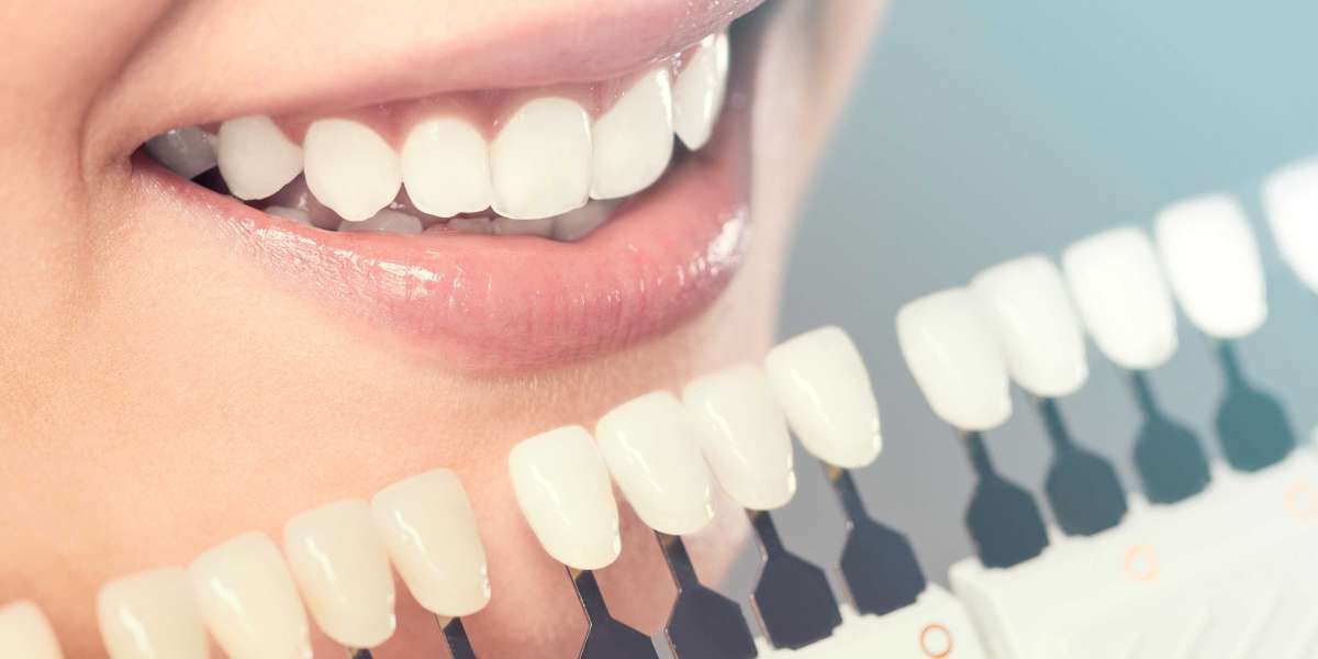 Transform Your Smile with Porcelain Veneers Services in McKinney, TX