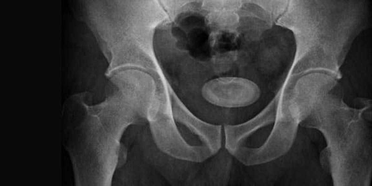 Best Surgical Treatment for Bladder Stone Removal