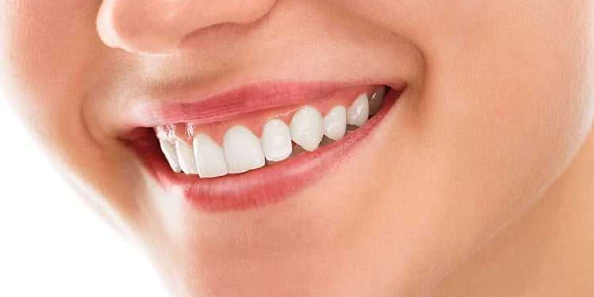 smile design in coimbatore | shaadaesthetics dental clinic in coimbatore
