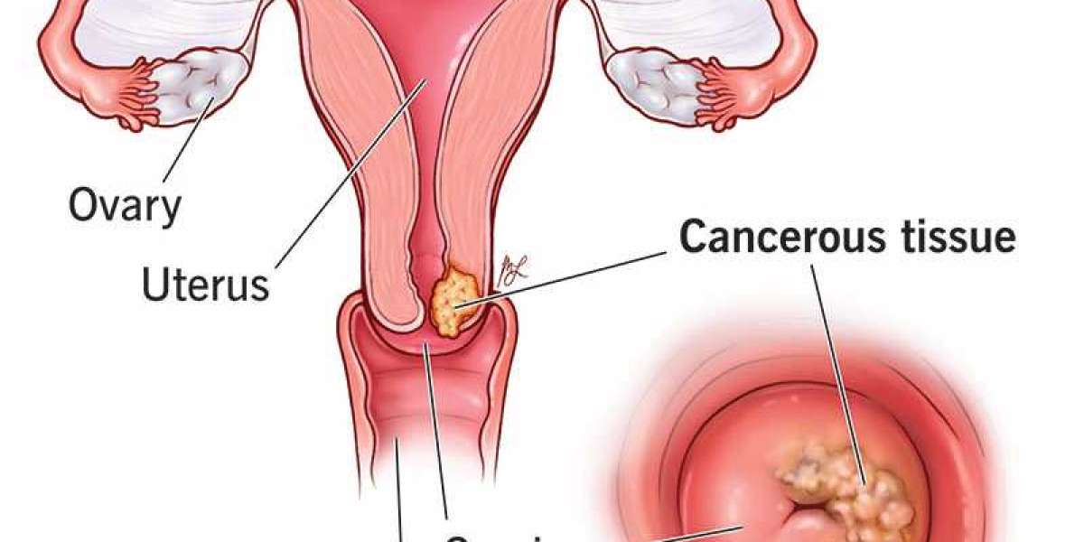 Cervical Cancer And Psychological Support For Patients