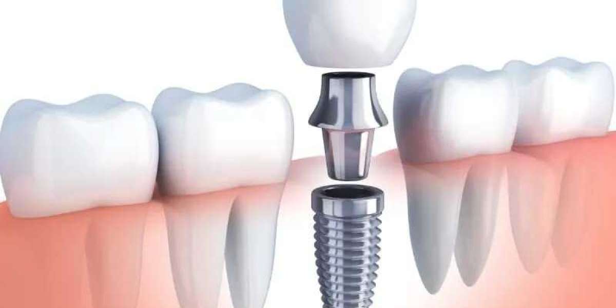 Understanding Teeth Grinding: Causes, Effects, and Treatment Options
