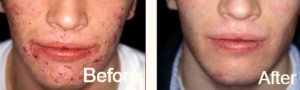 Acne Face Spot Treatments London | Dermatologist London Acne